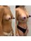 Best Clinic Istanbul - BREAST ENLARGMENT   