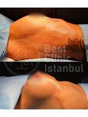 Breast Implants - Best Clinic Istanbul