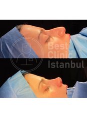 Rhinoplasty - Best Clinic Istanbul