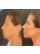 Best Clinic Istanbul - DEEP PLANE FACE AND NECK LIFT   