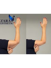 Arm Lift - Zara Esthetic