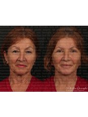 Facelift - Dr. Ali Rıza Öreroğlu Aesthetic Clinic