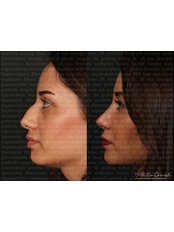 Rhinoplasty - Dr. Ali Rıza Öreroğlu Aesthetic Clinic