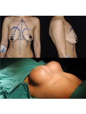 Breast Implants - Dr Baran Kul