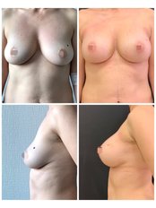 Breast Implants - Dr Tamer Şakrak Kliniği