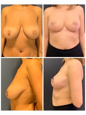 Breast Reduction - Dr Tamer Şakrak Kliniği