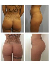 Butt Implants - Dr Tamer Şakrak Kliniği