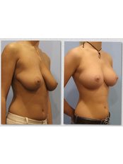 Breast Lift (with/without implant) - Dr Tamer Şakrak Kliniği