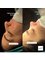 Dr.Ümit Hardal Central Hospital - Thick tip nose 