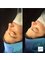 Dr.Ümit Hardal Central Hospital - Revision rhinoplasty 