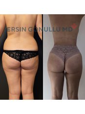 Butt Lift - Ersin Gonullu Clinic