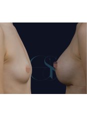 Breast Implants - Gokhan Semerci Clinic