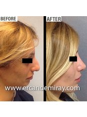 Open Rhinoplasty - Dr Ercan Demiray MD, Aesthetic and Plastic Surgeon