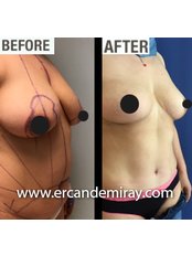 Breast Reduction - Dr Ercan Demiray MD, Aesthetic and Plastic Surgeon