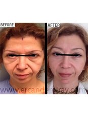 Endoscopic Facelift - Dr Ercan Demiray MD, Aesthetic and Plastic Surgeon