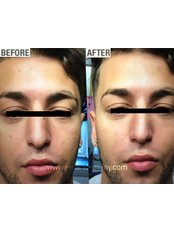 Secondary Rhinoplasty (Patients who had rhinoplasty surgery before) - Dr Ercan Demiray MD, Aesthetic and Plastic Surgeon