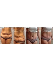 Full Abdominoplasty - Dr Ercan Demiray MD, Aesthetic and Plastic Surgeon
