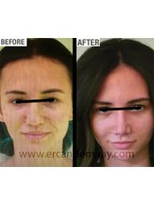 Secondary Rhinoplasty (Patients who had rhinoplasty surgery before) - Dr Ercan Demiray MD, Aesthetic and Plastic Surgeon