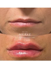 Lip Filler - Dr Merve Selim Clinic