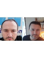 Hair Transplant - Estetica Istanbul