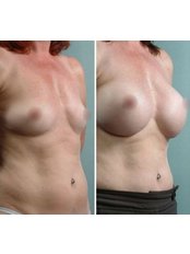 Breast Implants - Flora Klinik