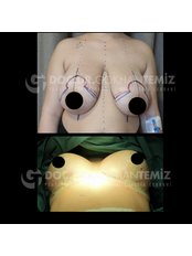 Breast Reduction - Gökhan Temiz Clinic İstanbul