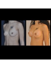 Breast Implants - Gökhan Temiz Clinic İstanbul