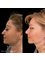 Jolie Bianca Health Care - Rhinoplasty Operation Before & After 