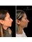 Jolie Bianca Health Care - Rhinoplasty Operation Before & After 