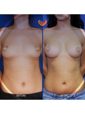 Breast Implants - Medconsultist Plastic Surgery