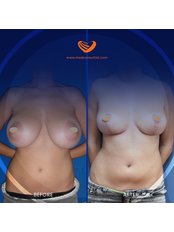 Breast Reduction - Medconsultist Plastic Surgery