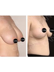 Breast Reduction - Op. Dr. Can Zeliha GUL