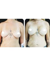 Breast Implants - Op. Dr. Can Zeliha GUL