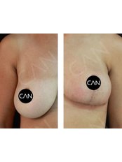 Breast Lift - Op. Dr. Can Zeliha GUL