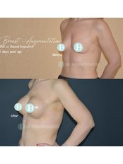 Breast Implants - Op. Dr. Hakan Demirel - Plastic And Aesthetic Surgeon