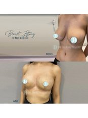 Breast Lift - Op. Dr. Hakan Demirel - Plastic And Aesthetic Surgeon