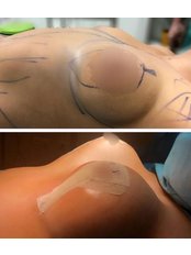 Breast Implants - Rise Aesthetics and Plastic Surgery