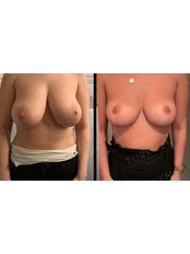Breast Reduction - TURKMEN EXCLUSIVE