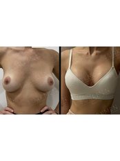 Breast Implants - TURKMEN EXCLUSIVE