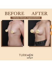 Breast Implants - TURKMEN EXCLUSIVE