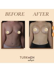 Breast Lift - TURKMEN EXCLUSIVE