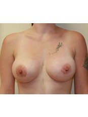 Breast Lift - Boğaziçi Estetik