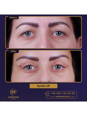Eyelid Surgery - Estherian clinic