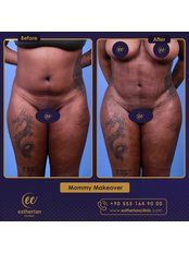 Liposuction - Estherian clinic