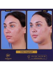 Chin Implant - Estherian clinic