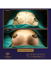 Breast Implants - Estherian clinic