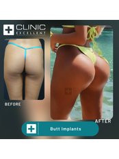 Butt Implants - Clinic Excellent