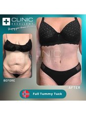 Full Abdominoplasty - Clinic Excellent