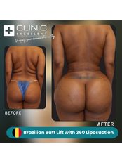 BBL - Brazilian Butt Lift - Clinic Excellent