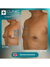 Gynecomastia - Clinic Excellent